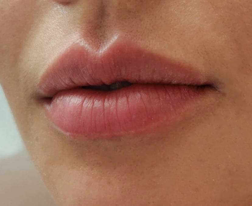 Esculpindo Lábios com Naturalidade